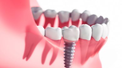 Dental Implants Culver City: 6 Questions To Ask Before Surgery