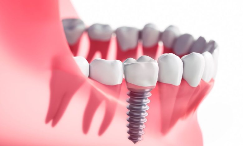 Dental Implants Culver City: 6 Questions To Ask Before Surgery
